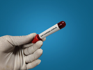 Fototapeta premium Doctor holds blood samples for Anti Cardiolipin antibody test, autoimmune disease test in the laboratory background.