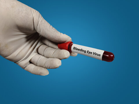 Doctor holds blood samples for Bleeding Eye Virus test in the laboratory background.