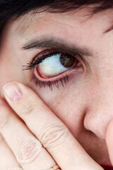 An eyelash fell out and got into a person's eye, close-up.