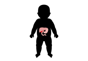 Biliary atresia disease