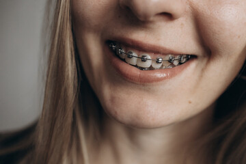 A girl with braces. Visit to the dentist. Beautiful smile