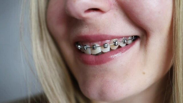 A girl with braces. Visit to the dentist. Beautiful smile