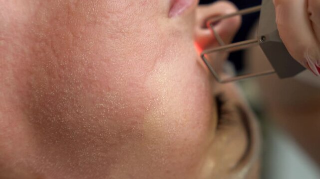 Beautician cosmetologist doing procedure fractional microneedle mesotherapy rejuvenation with laser technology. Hardware cosmetology in clinic salon for client.