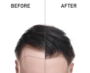 Man suffering from baldness on white background, closeup. Before and after treatment, collage