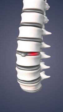Human spine bulging or herniated disc