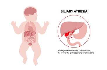 Biliary atresia disease