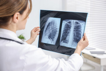 Doctor examining lungs x-ray in hospital, closeup