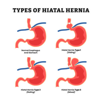 Different types of hiatal hernia types, educational medical poster design healthcare scheme, labeled normal esophagus and stomach, hiatal hernia types : sliding, rolling, mixed. Stomach Heartburn. 
