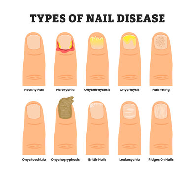 Different types of nail disease disorder types, educational medical poster design healthcare scheme, labeled healthy nail, paronychia, onychomycosis, onycholysis, pitting, brittle, leukonychia.