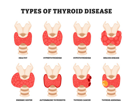 Different types of thyroid disease types, educational medical poster design healthcare scheme, labeled hyperthyroidism, hypothyroidism, graves disease, endemic goiter, cancer, adenoma, autoimmune.