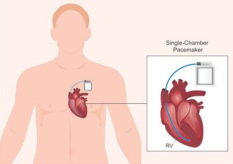Single chamber pacemaker.Type of pacemaker.