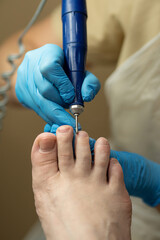 Podiatry specialist files toenails using electric drill in clinic setting. Chiropody and podology concept, foot care