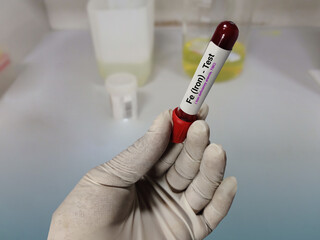 Doctor holds blood sample for Transferrin test. Iron deficiency anemia, TIBC. Medical test tube in...
