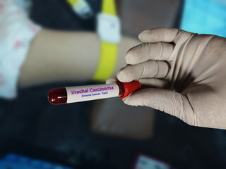 Doctor holds blood samples for Urachal carcinoma (Urachal Cancer) test in the hospital background.