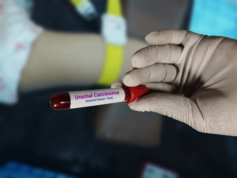Doctor holds blood samples for Urachal carcinoma (Urachal Cancer) test in the hospital background.