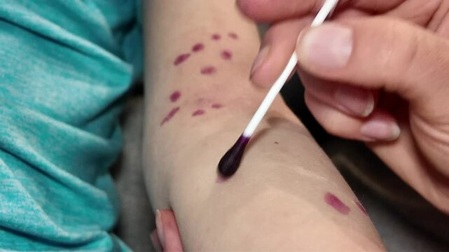 child illness skin rash epidemic with vaccination indoors