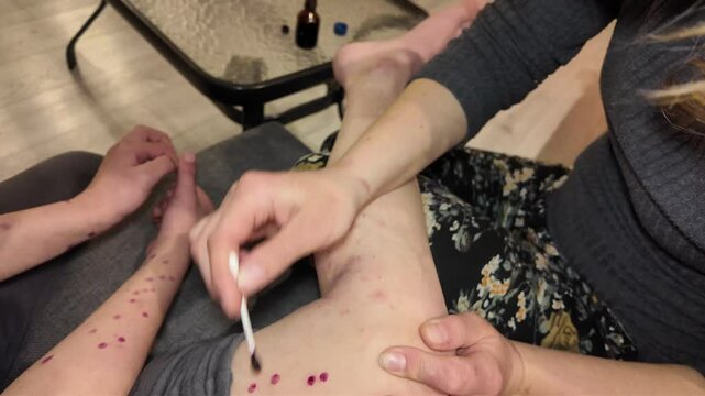 child illness skin rash epidemic with vaccination indoors