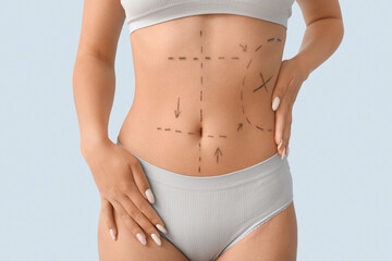 Young woman in underwear with marks on her abdomen against light background, closeup. Plastic...