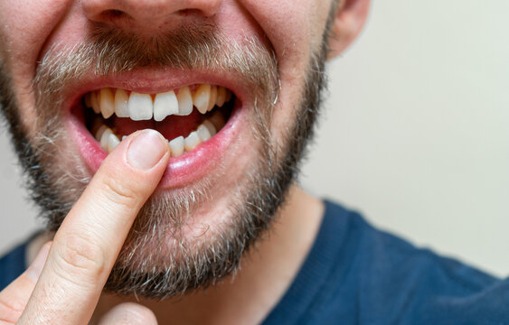 close up of a broken tooth, young adult showing teeh