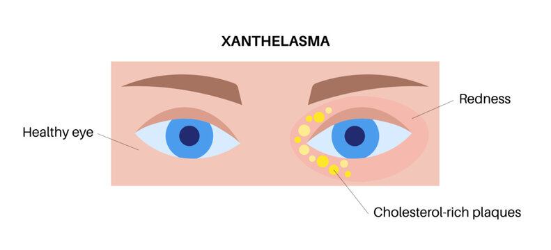 Xanthelasma skin disease