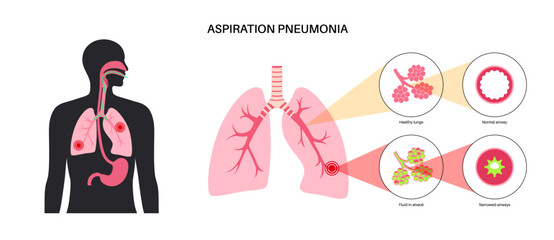 Aspiration pneumonia poster