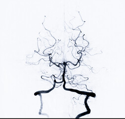 A cerebral angiogram showing the detailed blood vessels in the brain.