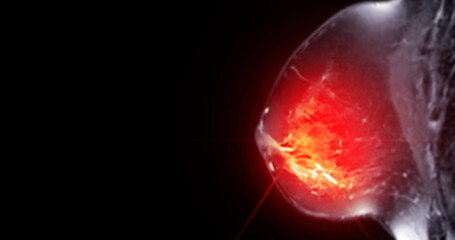 A breast MRI scan with an area highlighted in red, suggesting a potential abnormality that requires further investigation, such as a tumor or cyst.