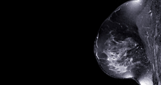 MRI scan of the breasts in an Sagittal view with contrast enhancement.