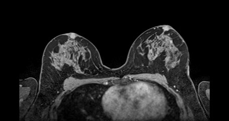 MRI scan of the breasts in an axial view with contrast enhancement.
