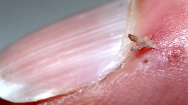 Fingernail Health Problem: Close Up View of Hangnail Skin Detail
