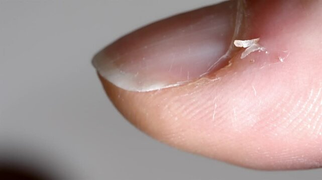 Hangnail on Finger Close Up - Damaged Cuticle Detail Shot