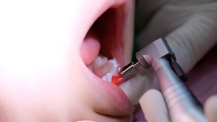 Professional dentist carefully polishing young patient's teeth using modern dental drill, ensuring...
