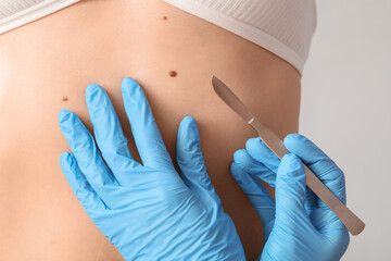 Surgeon with scalpel and mole on woman's belly against light background, closeup