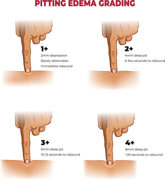 illustration of pitting edema grading infographic