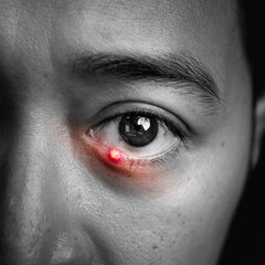 Close Up of Adult Man with one eye infection, Chalazion, Stye (hordeolum) on eyelid.