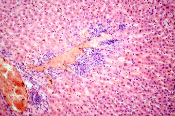 Coccidia in liver, photomicrograph showing intracellular parasitic protozoa causing hepatic coccidiosis with inflammation and hepatocellular damage.