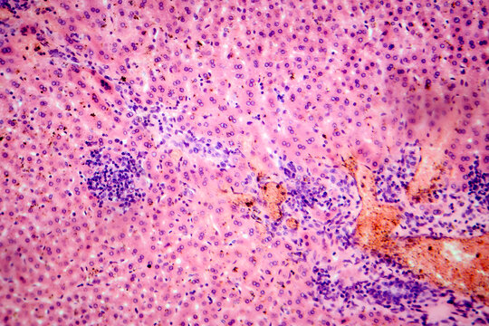 Coccidia in liver, photomicrograph showing intracellular parasitic protozoa causing hepatic coccidiosis with inflammation and hepatocellular damage.