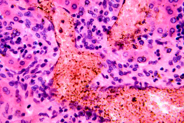 Coccidia in liver, photomicrograph showing intracellular parasitic protozoa causing hepatic...