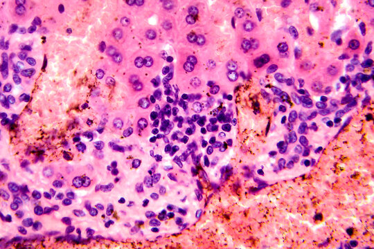 Coccidia in liver, photomicrograph showing intracellular parasitic protozoa causing hepatic coccidiosis with inflammation and hepatocellular damage.