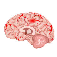 cerebrovascular accident, stroke, or cerebral infarction with a thrombus or blood clot
