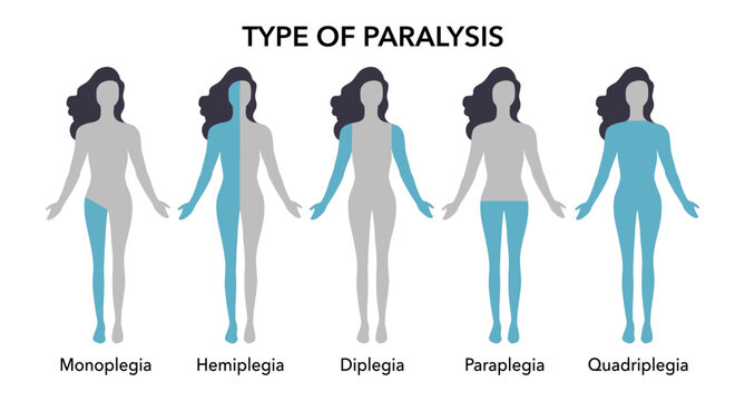 Types of paralysis and limb body parts as medical condition outline diagram. Labeled educational scheme with monoplegia, hemiplegia, diplegia and paraplegia disorder differences vector illustration.