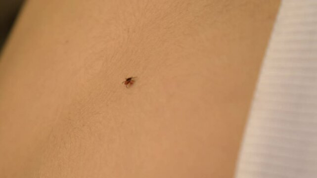 Tick on human body. Selective focus.