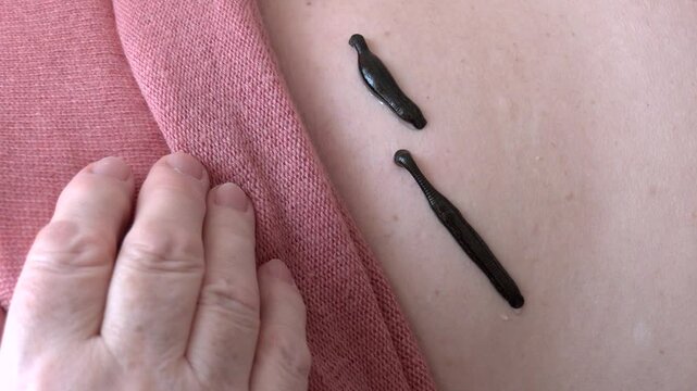 Medical Leeches on the Human Body Drink Blood. Treatment with leeches. Medicinal Leech - Hirudo medicinalis - leech bite, leech is sucking blood on the human body.
