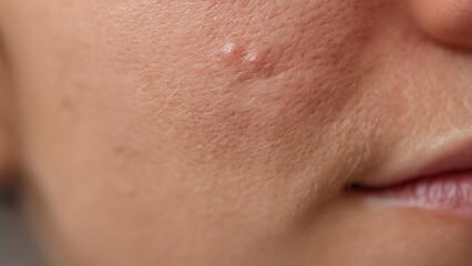 Closeup of a pimple on the skin