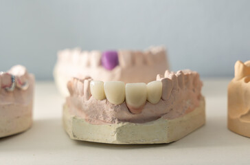 Close-up of a dental prosthetic model with artificial teeth and gums on a wooden surface. Ideal for dental care imagery