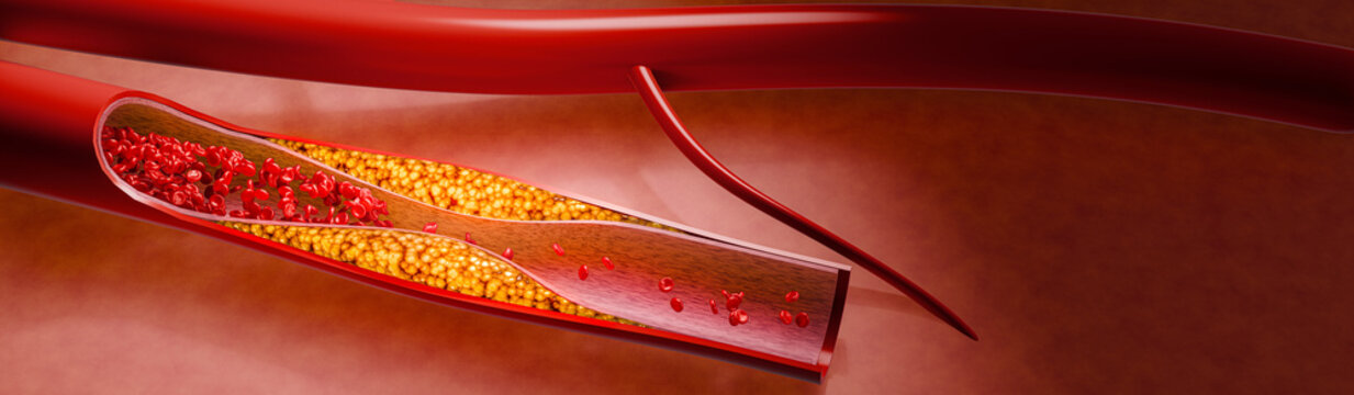 Hyperlipidemia or arteriosclerosis. Blocked artery concept and human blood vessel as a disease with cholesterol fat buildup clogging. Clogged arteries, Cholesterol plaque in the artery. 3D Rendering
