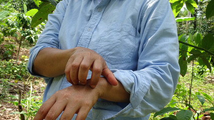 A farmer scratching his itchy hand from an insect bite while working in the garden