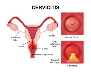 Cervicitis Inflammed cervix infections illustration