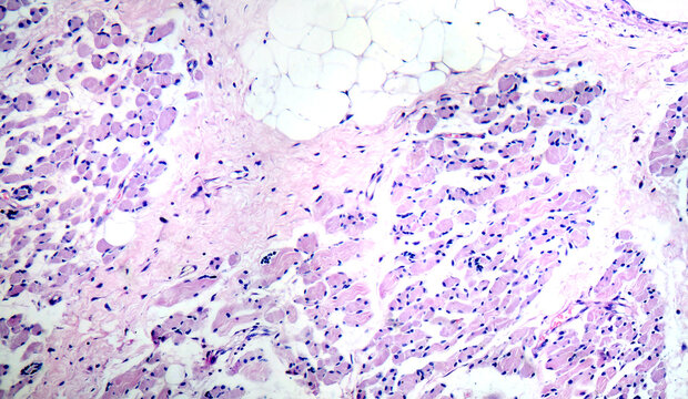 Skeletal muscle atrophy, photomicrograph showing decreased fiber size with increased spacing between them, reduced myofibrils, increased endomysial connective tissue with fatty infiltration