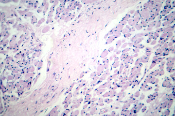 Skeletal muscle atrophy, photomicrograph showing decreased fiber size with increased spacing...